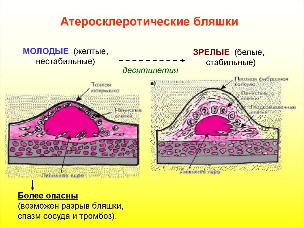 Как уменьшить бляшку