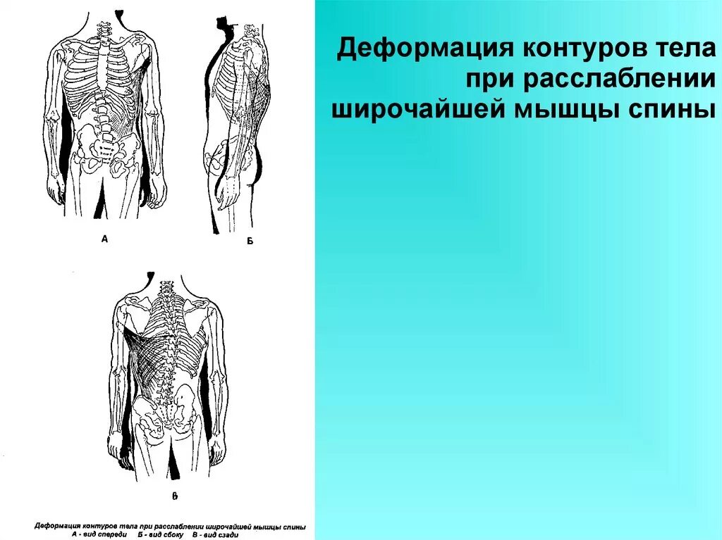 Искривление мышц. Деформация контуров тела. деформация контуров тела при укорочении. контур мышц спины вид спереди и сзади.