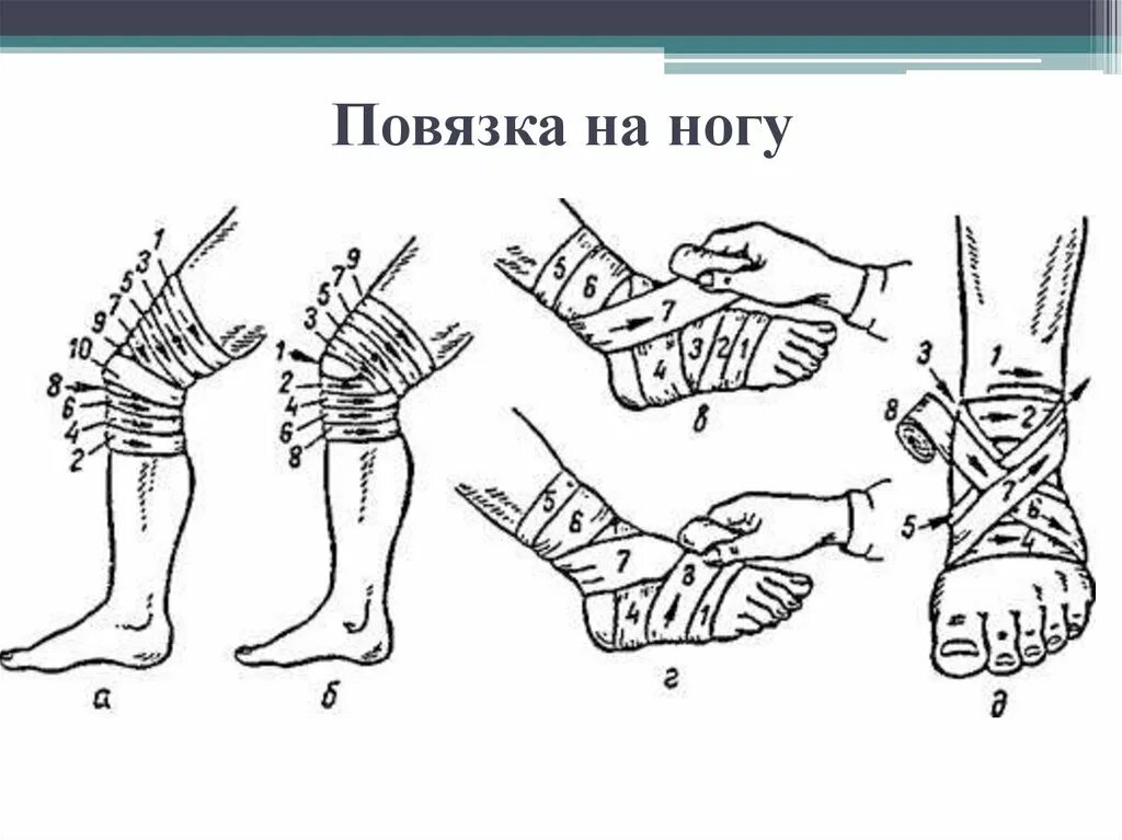 Какая повязка накладывается при повреждении голеностопного сустава. Наложение бинтовых повязок на конечности. Повязки на нижнюю конечность десмургия. Правила наложения повязок на нижние конечности. Техника наложения повязок на нижнюю конечность.