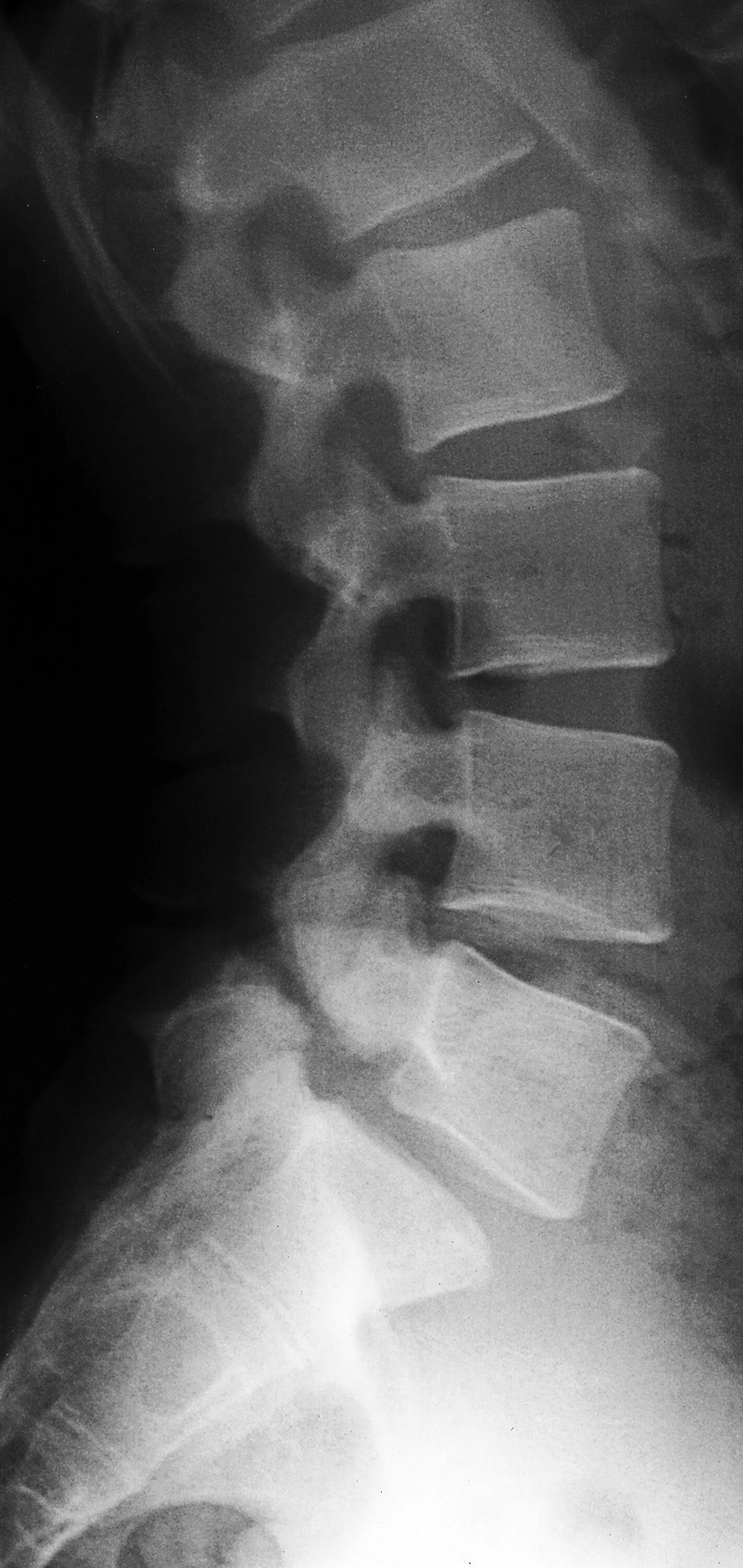 Spondylolisthesis xray. Ретролистез l3-l4. Спондилолистез л5. Спондилолистез шейного отдела позвоночника. Спондилолистез шейного отдела позвоночника.