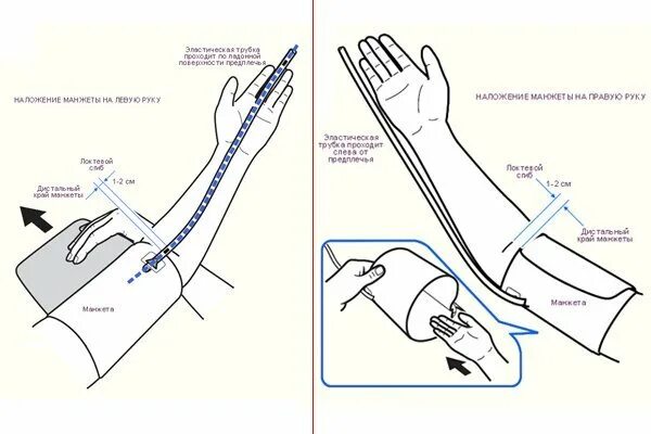 Разница ад на руках. Манжету для измерения артериального давления необходимо наложить. При измерении ад манжету тонометра накладывают на. Как правило надевать манжетку при измерении давления. Как правильно накладывать манжету при измерении.