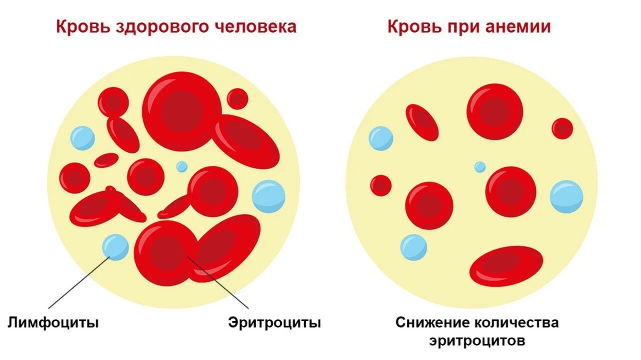 Постгеморрагическая анемия гемоглобин. Эритроциты при железодефицитной анемии. Железодефицитная анемия картина крови. Гемолитическая анемия картина крови.