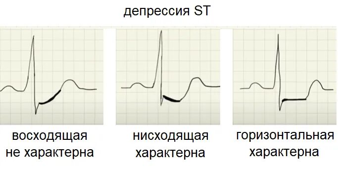 Эпизод депрессии st. Косовосходящая депрессия сегмента St на ЭКГ. Косонисходящая депрессия сегмента St. Корытообразная депрессия сегмента St. Элевация St депрессия St.