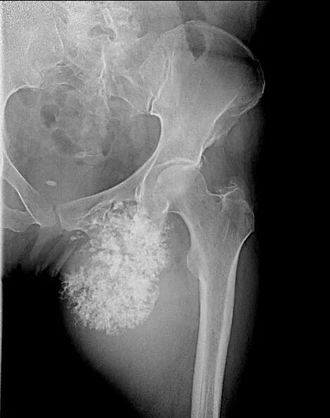 Саркома тазобедренного. Остеосаркома бедренной кости рентген. Хондросаркома бедренной кости рентген. Остеогенная саркома бедренной кости рентген. Остеосаркома тазобедренного сустава на рентгене.