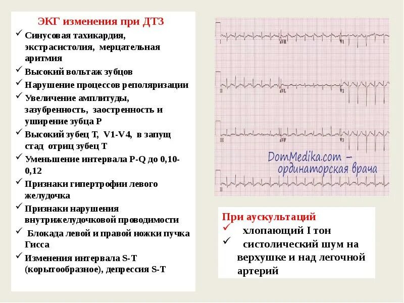 Болезни на экг. Тиреотоксикоз изменения на ЭКГ. ЭКГ зазубренность на зубце r. Изменения на ЭКГ при тиреотоксикозе.