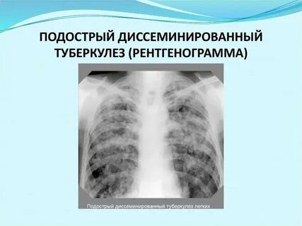 Диссеминированного туберкулеза легких