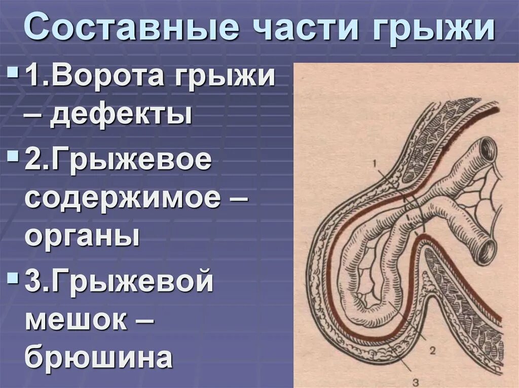 Грыжа как правильно называется. Грыжа как правильно называется