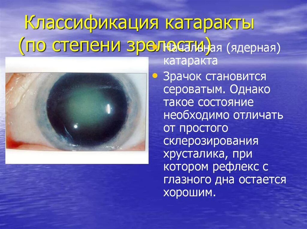 Переднекапсулярная катаракта. Классификация катаракты по степени зрелости. Катаракта глаза глазное дно. Начальная ядерная катаракта. Начальная старческая катаракта