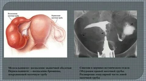 Лечение воспаления маточных труб