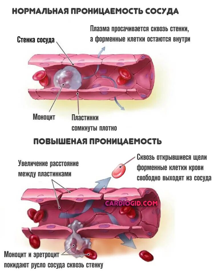 Повышенип проницаемости со. Повышенная проницаемость сосудов. Повышение сосудистой проницаемости. Проницаемость стенок сосудов. Звонкий сосуд