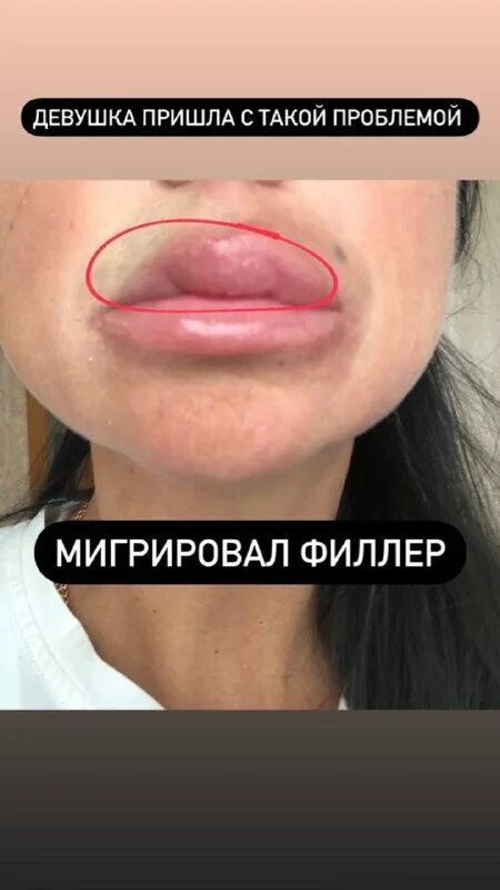 Губы после выведения филлера. Накачивание губ гиалуроновой кислотой. Губы после выведения филлера. Выведение филлеров лонгидазой осложнение. Губы после выведения филлера.