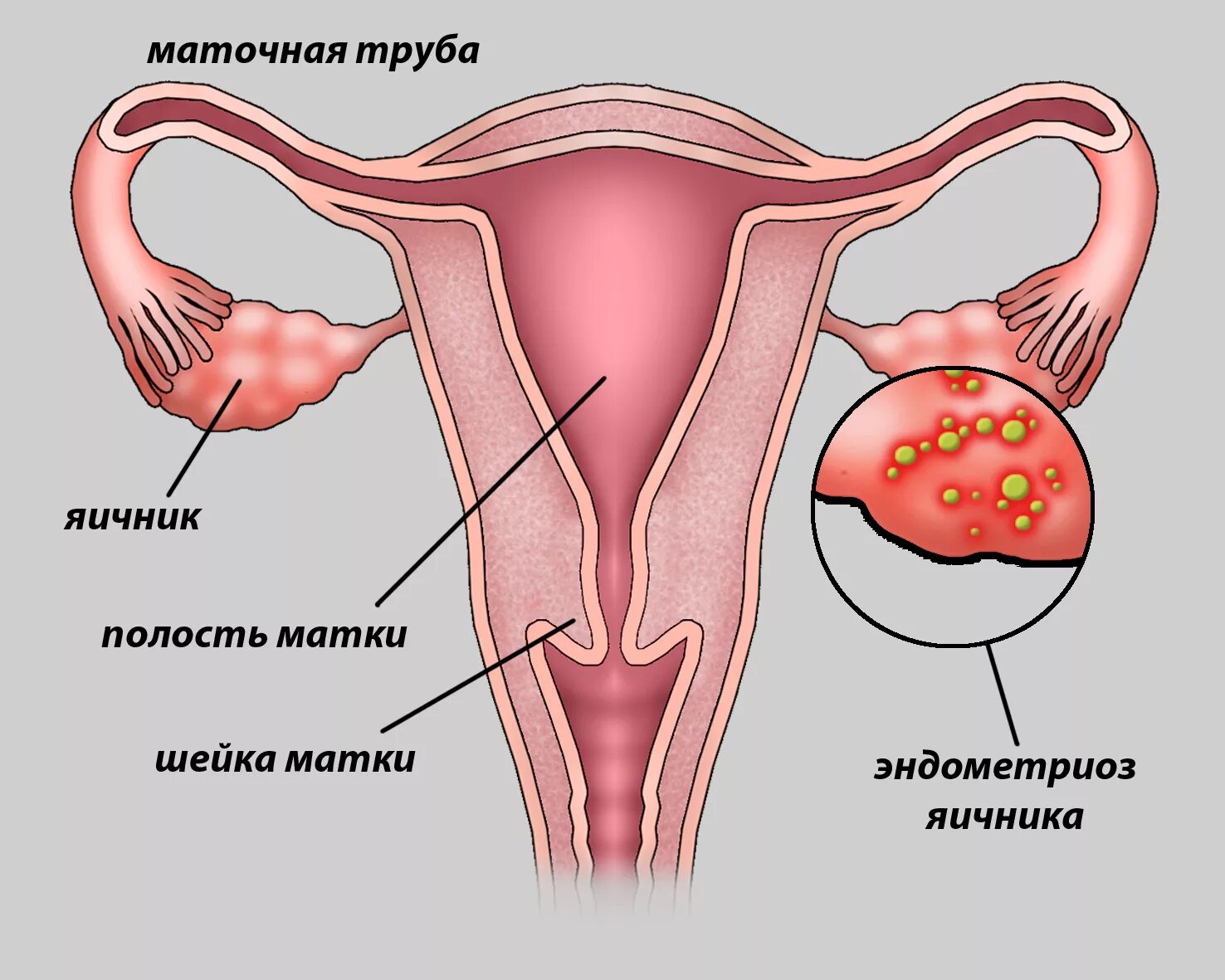 Эндометрия у девочек