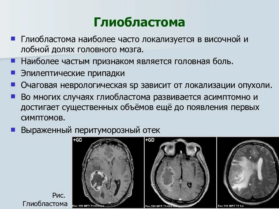 Можно ли вылечить рак мозга. Глиобластома головного мозга 4 степени. неоперабельная глиобластома головного мозга. глиобластома лобной доли мрт. глиобластома затылочной доли.