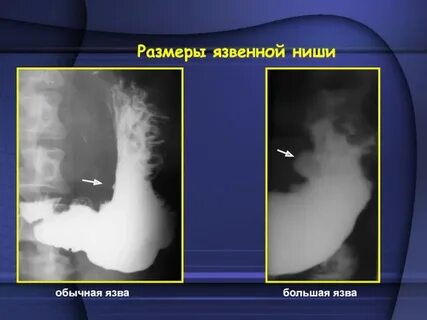 Симптом ниши