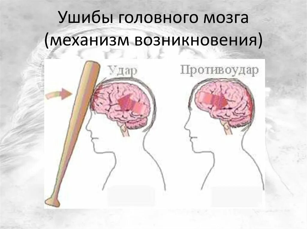 Механизмы ушиба головного мозга. Основные симптомы ушиба головного мозга. Тяжелый ушиб головного мозга. Легкое сотрясение головы