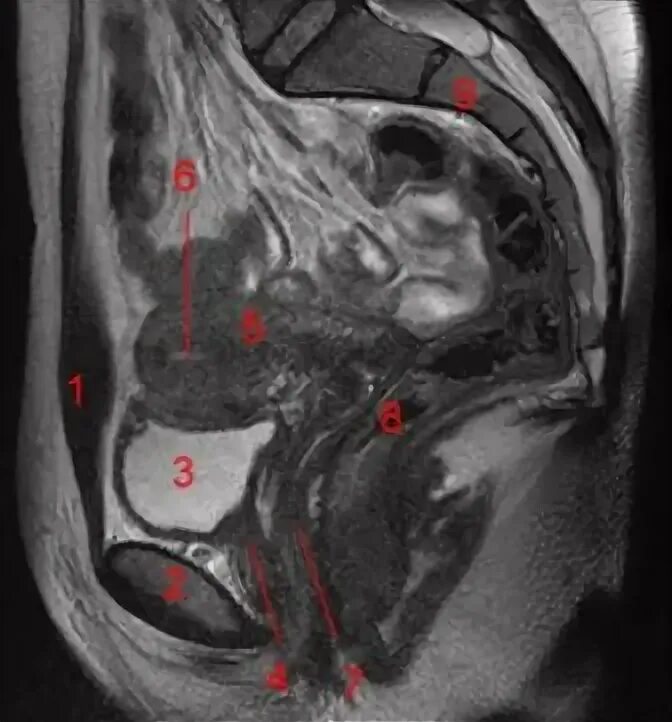 Кт органов таза у мужчин. Спаечная болезнь малого таза мрт. Малый таз мрт анатомия. Мрт ОМТ. Мрт малого таза сагиттальная.