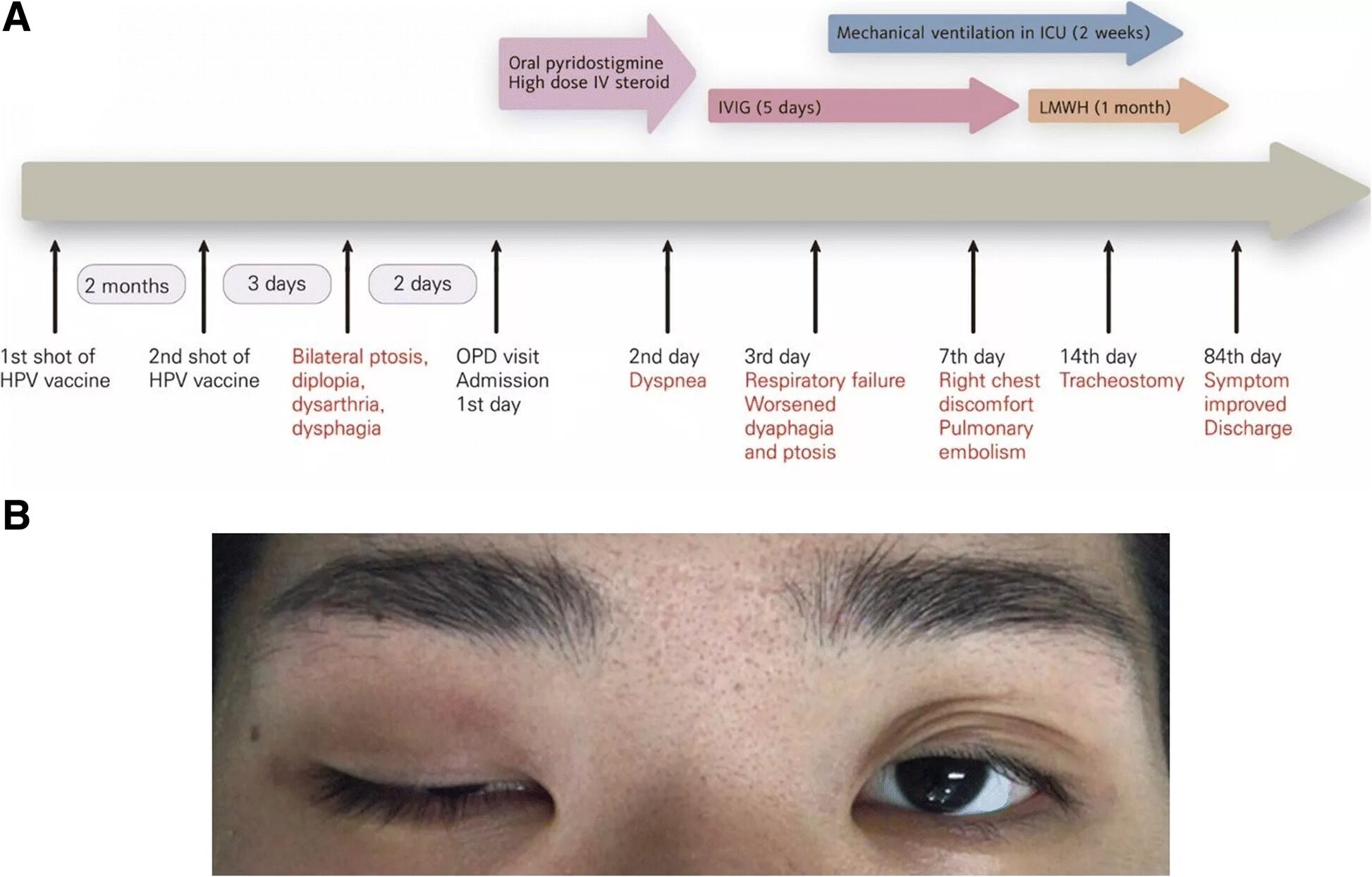 Ptosis латынь. Миастения гравис. антиптозис препарат. evasion dermafile dna anti ptosis.