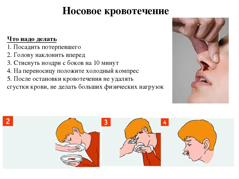 Остановить кровотечение из носа. При кровотечении из носа. Остановка кровотечения из носа. Как остоновитькрофь из носа. Кровь из носа правая ноздря