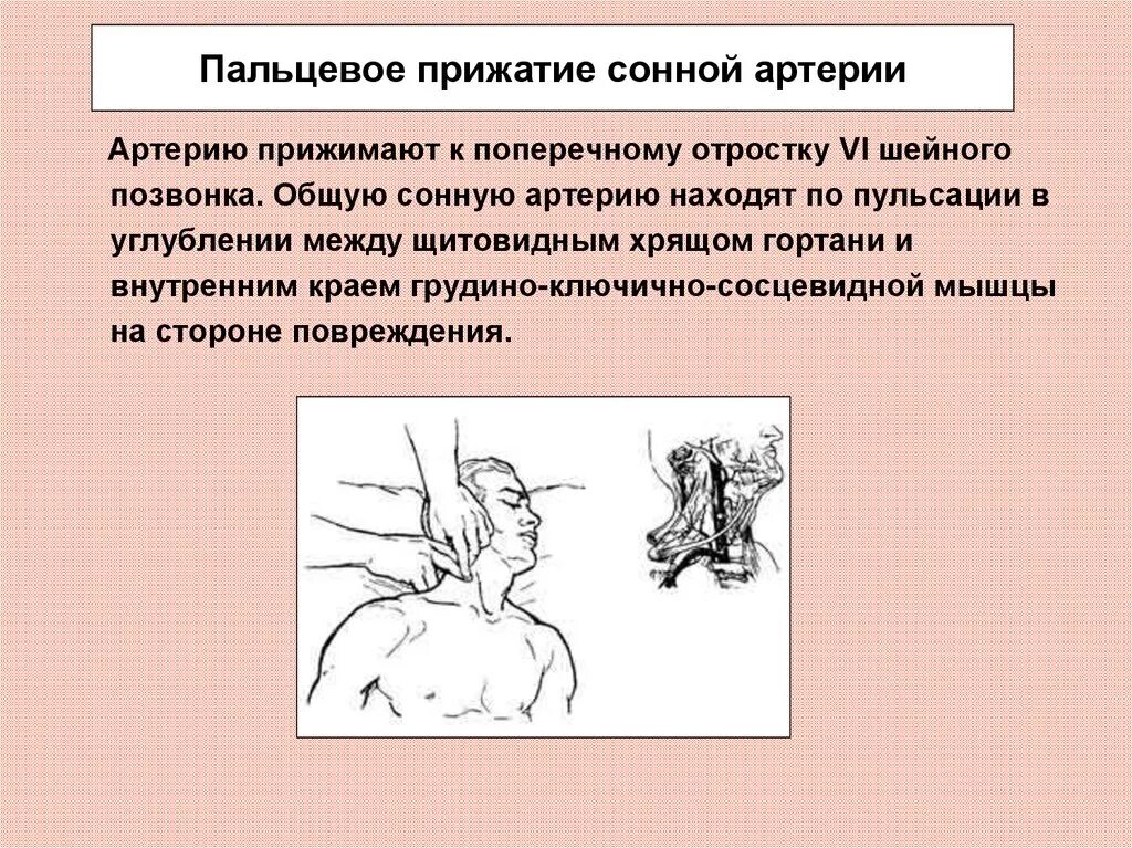 Остановить кровотечение на сонной артерии ответ тест. Пальцевое прижатие сонной арте. Прижатие общей сонной артерии. Пальцевое прижатие сонной артерии. Пальцевое прижатие артерий сонной артерии.