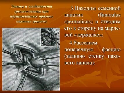 Прямые паховые грыжи операции