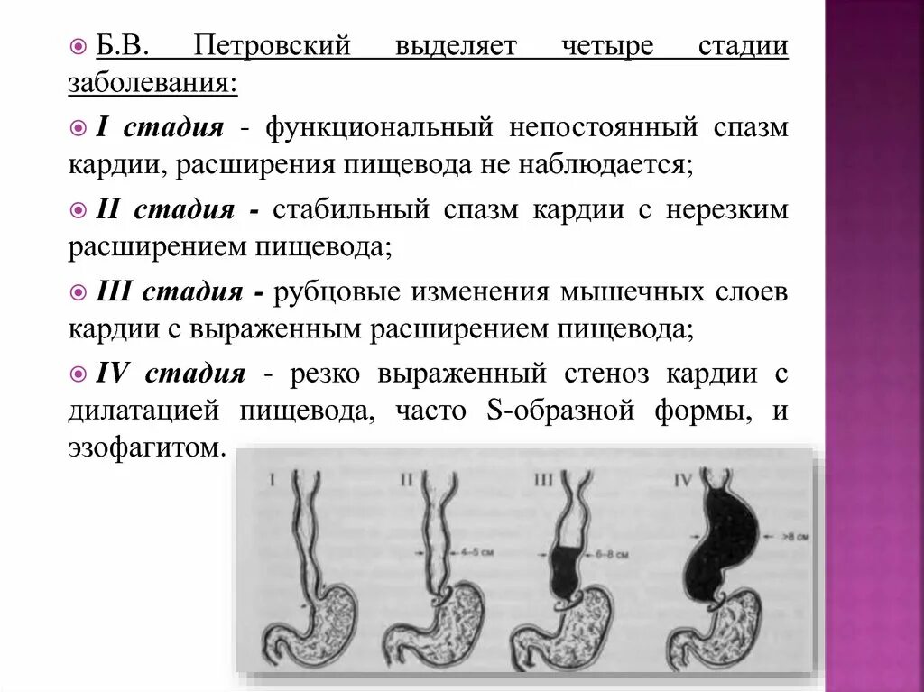 Степени расширения пищевода. Халазия кардии пищевода. Халазия кардии 1 степени.