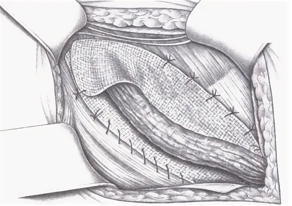 Лихтенштейн операция паховая грыжа. Грыжесечение по Лихтенштейну. Герниопластика по Лихтенштейну. Герниопластика по Лихтенштейну паховой грыжи. Лихтенштейн операция паховая