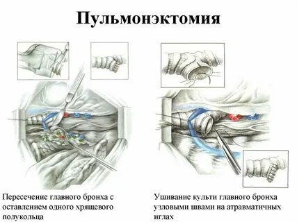 Пульмонэктомия