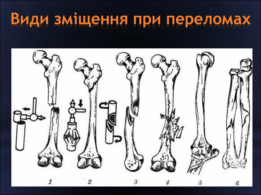 Перелом со смещением костных отломков. Классификация смещений костных отломков. Типы смещения трубчатых костей. Смещение отломков костей.