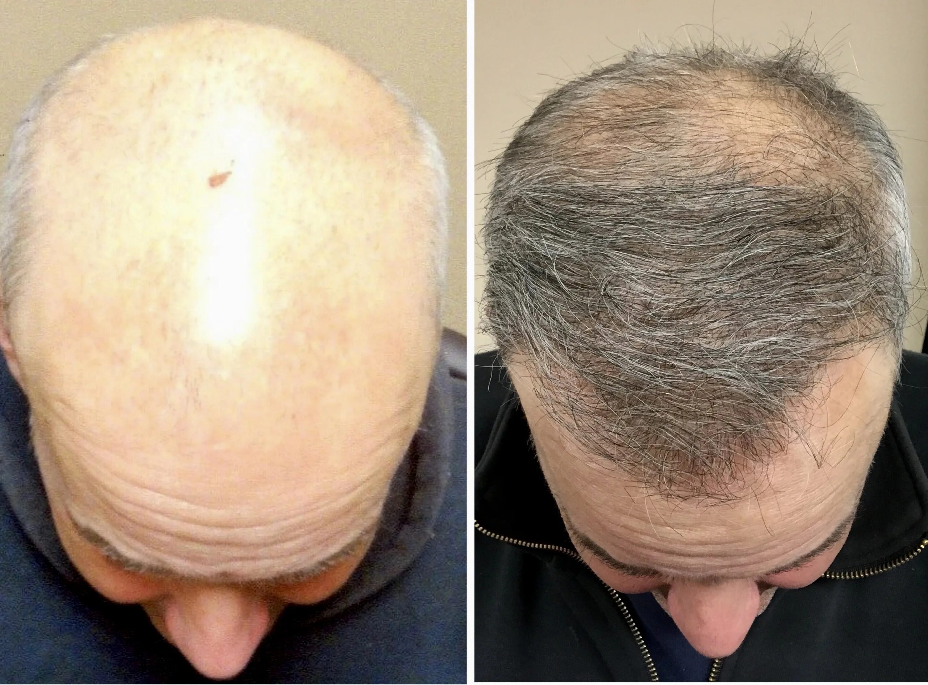 2500 Hair transplant. Волосы после пересадки волос. Голова после пересадки волос. Пересадка волос выпадают волосы