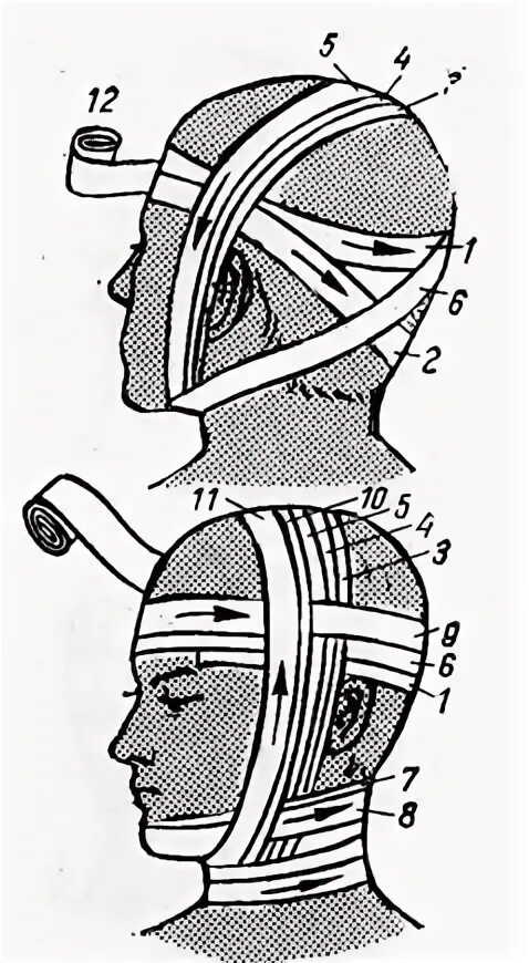 Десмургия повязка уздечка. Повязка уздечка техника наложения. Бинтовая повязка уздечка. Наложение повязки на голову уздечка. Повязка уздечка накладывается