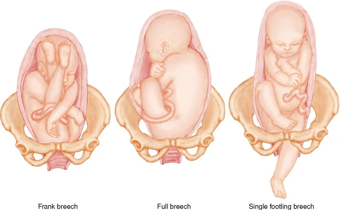Положение плода в животе. Тазовое предлежание плода 1 позиция. Позиции ребенка в животе. Расположение ребенка в тазовом предлежании. Положение ребенка в животе.