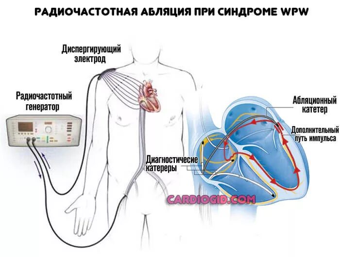 Где делают абляцию. Синдром ВПВ сердца после операции. Операция на сердце прижигание при аритмии. Нарушения ритма сердца РЧА. Высокочастотная абляция сердца.