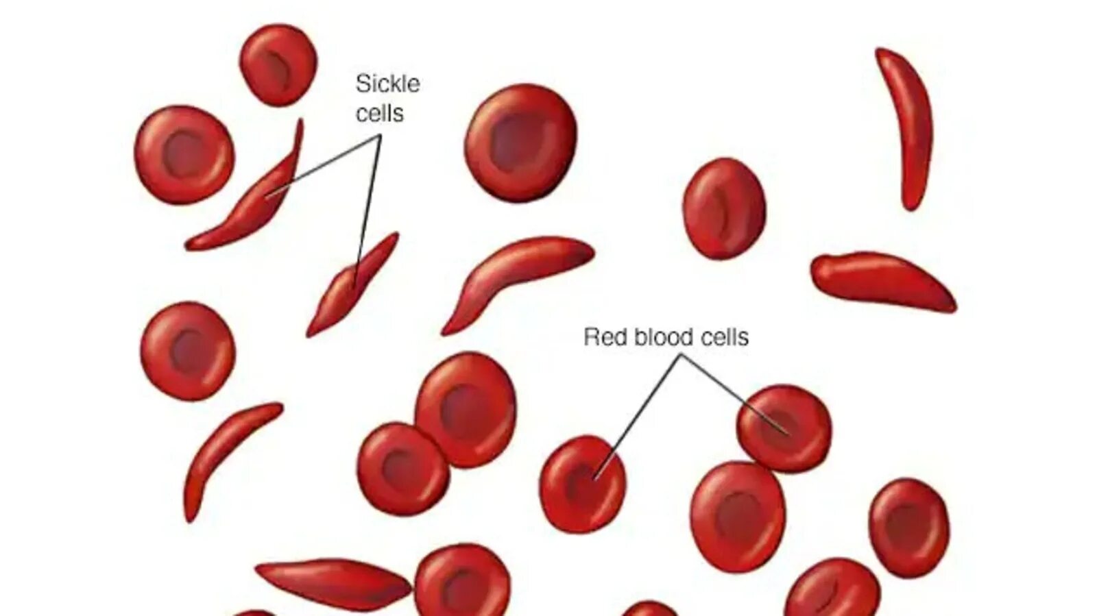 Эритроциты при серповидно клеточной анемии. Нормальные эритроциты. Серповидные эритроциты. Эритроциты при серповидноклеточной анемии.