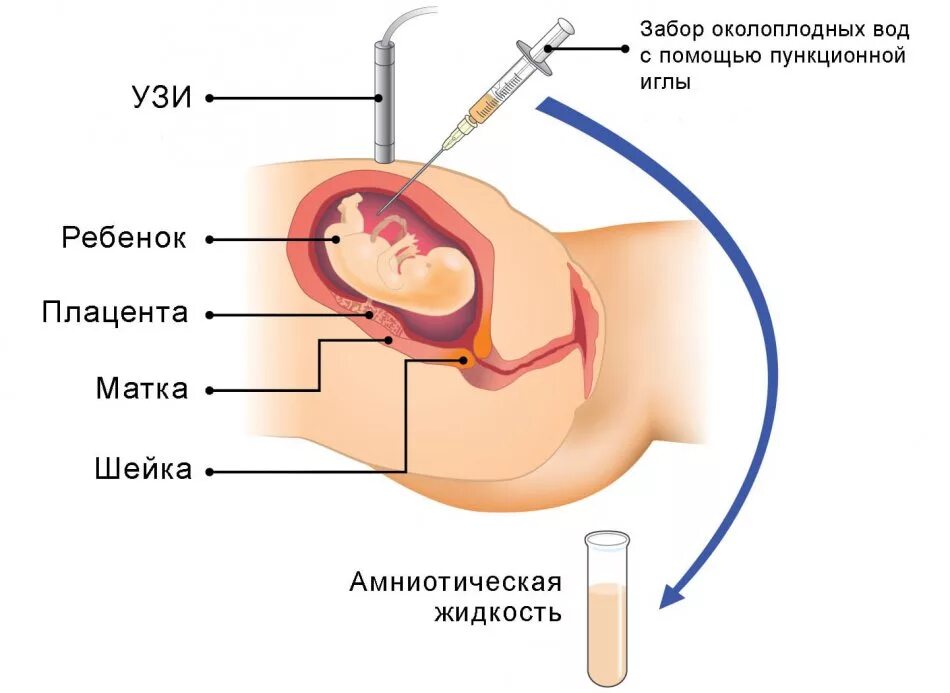 Исследование околоплодных вод амниоцентез. Схема проведения амниоцентеза. Пункционный адаптер амниоцентез. Трансабдоминальная биопсия хориона. От слюны можно забеременеть