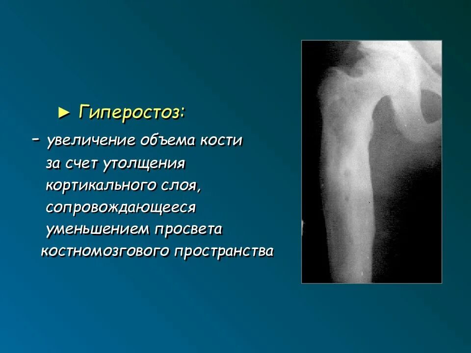 Периостальная реакция кости в рентгенологии. Периостоз. Оссифицирующий периостит рентген. Периостит кости голени. Периостоз.