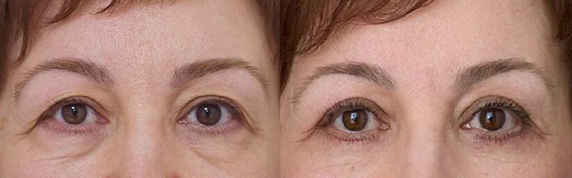 Блефаропластика верхних век в москве. Ленинск-кузнецкий блефаропластика век. Нависшее веко холодная плазма. Блефаропластика верхних век чита. Кантопексия/кантопластика нижних век.