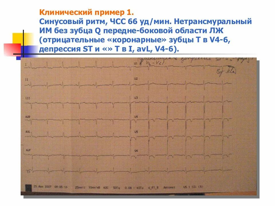 Кардиограмма заключение ритм синусовый. Частота сердечного ритма. Ритм синусовый чсс 86. Несинусовые ритмы экг. Ритм синусовый чсс 86.