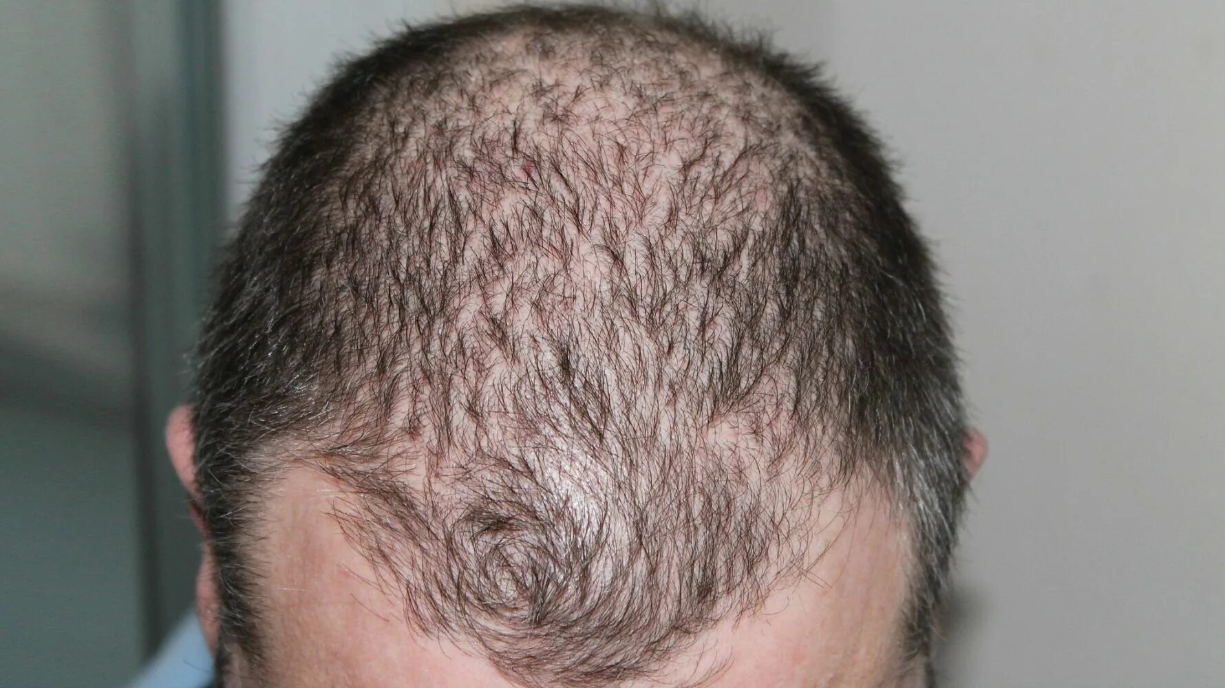 Гнёздная (очаговая алопеция). Очаговая алопеция (alopecia Areata). Андрогенная алопеция алопеция. Волосы дают мужчине