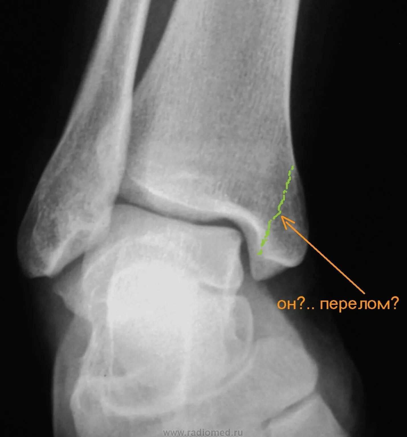 Голеностопный сустав рентген норма. Подвывих голеностопного сустава рентген. Голеностоп здоровый сустав рентген. Ушиб голеностопного сустава рентген.