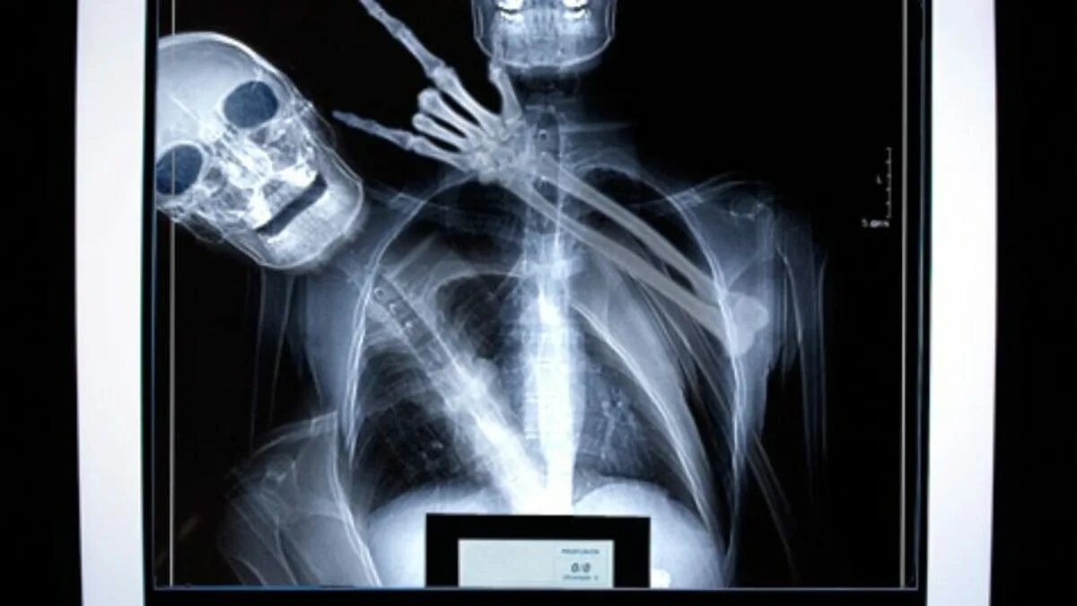 Source x rays