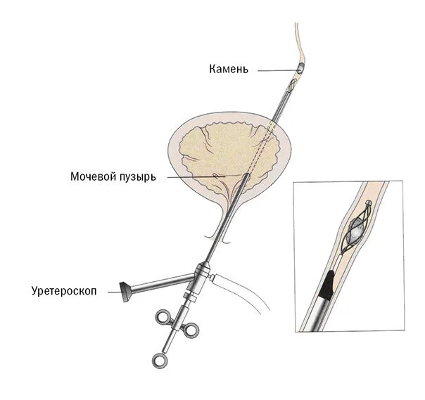Сколько стоит операция по удалению камней. Лазерная контактная литотрипсия камня мочеточника. Трансуретральная литотрипсия камней почек. Уретроскопия камни в мочеточнике. Ригидная уретероскопия.