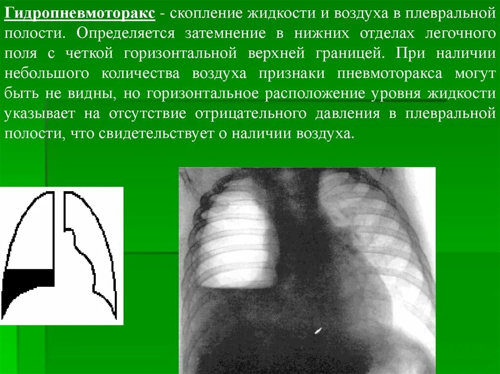 Признаки воздуха в легких. Гидропневмоторакс рентген. Гидропневмоторакс описание рентгенограммы. Гидропневмоторакс рентген заключение. Лучевая диагностика гидропневмоторакса.