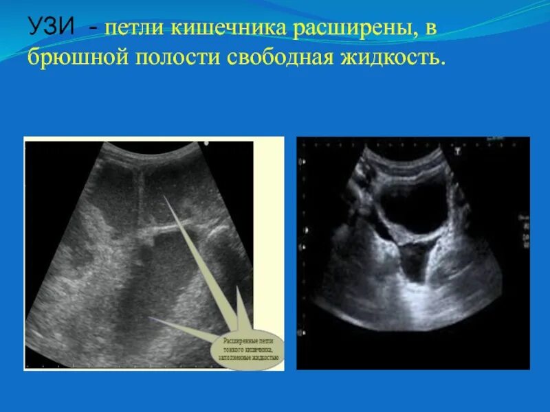 Асцит в малом тазу