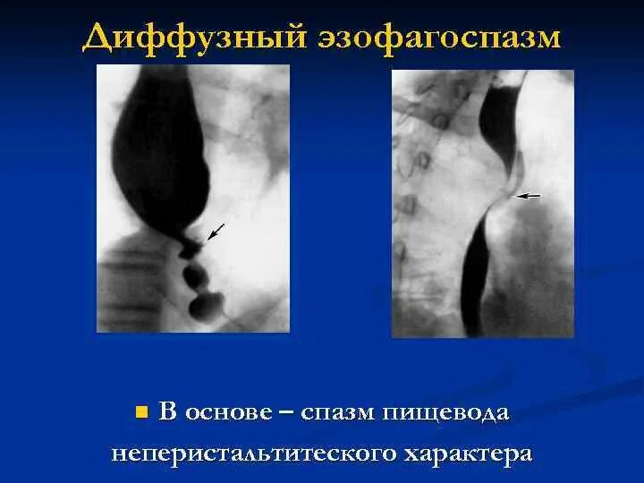 Спазм пищевода как снять приступ быстро Cпазм пищевода: причины, симптомы и лечение