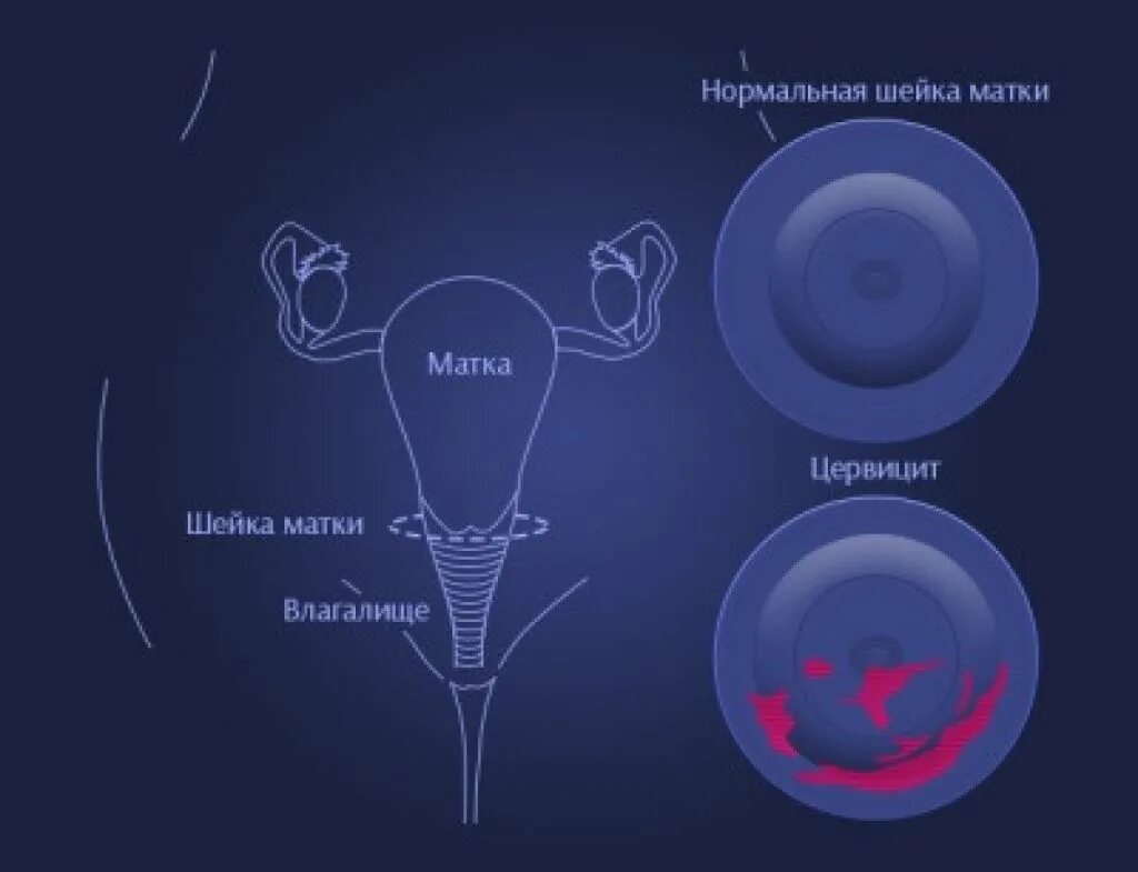 Цервикоз шейки матки. Цервикальный канал у женщин. цервикальный канал шейки матки.