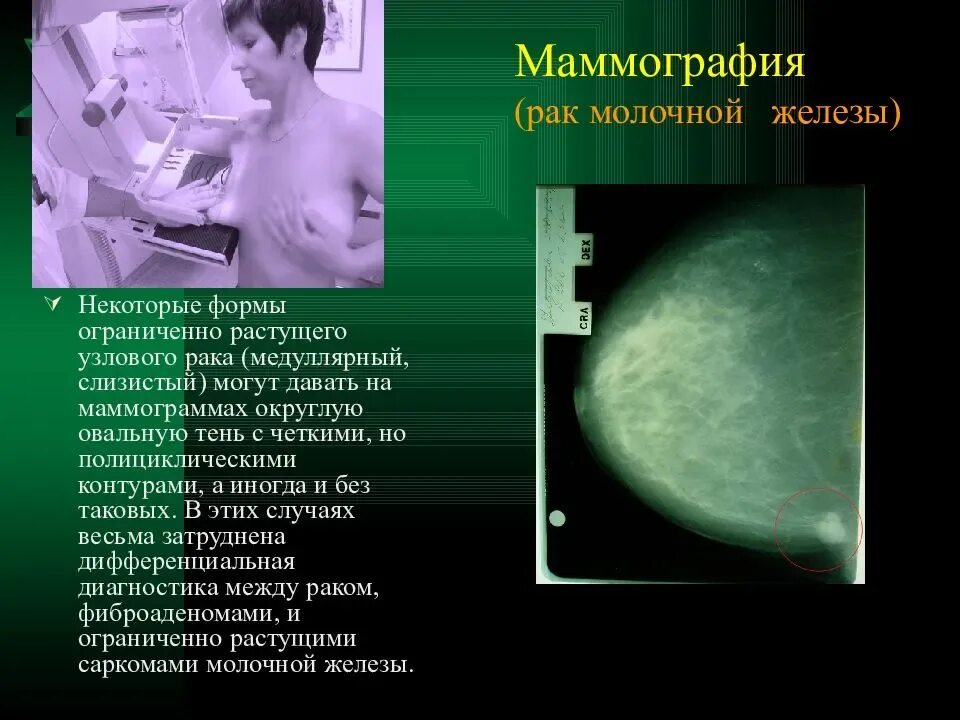 После операции опухоли молочной железы. Молочная железа маммография. Рик молочной железы маммографич. Онкология молочной железы. Маммограмма онкология.