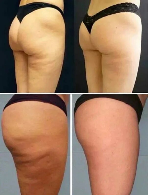 Целлюлит при похудении. Липолитики целлюлит до после. Обертывание живота до и после. Приседания от целлюлита до и после. Подтянутые ноги до и после.