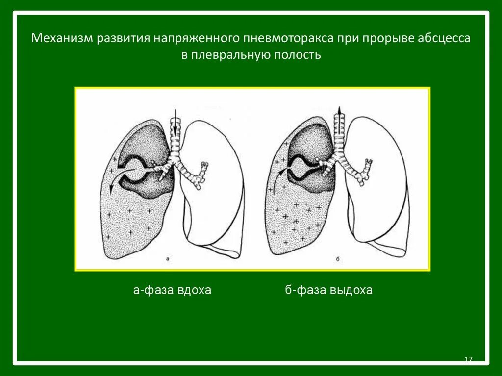 Пневмоторакс механизм. Механизм развития пневмоторакса. Внутренний пневмоторакс. Механизм напряженного пневмоторакса. Открытый пневмоторакс закрытый пневмоторакс клапанный.