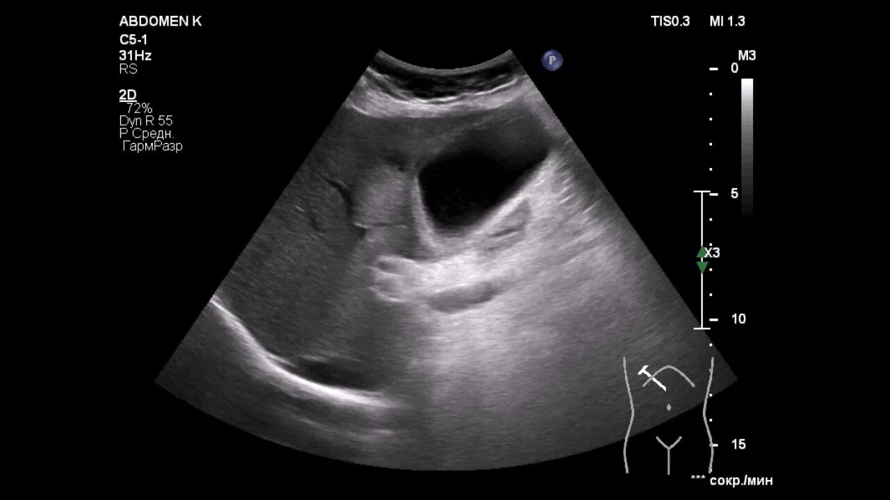 Узи перивезикальный абсцесс. Перивезикальный инфильтрат желчного пузыря. Инфильтрат желчного пузыря. Округлый инфильтрат кт. Инфильтрат осложнения желчный пузырь.
