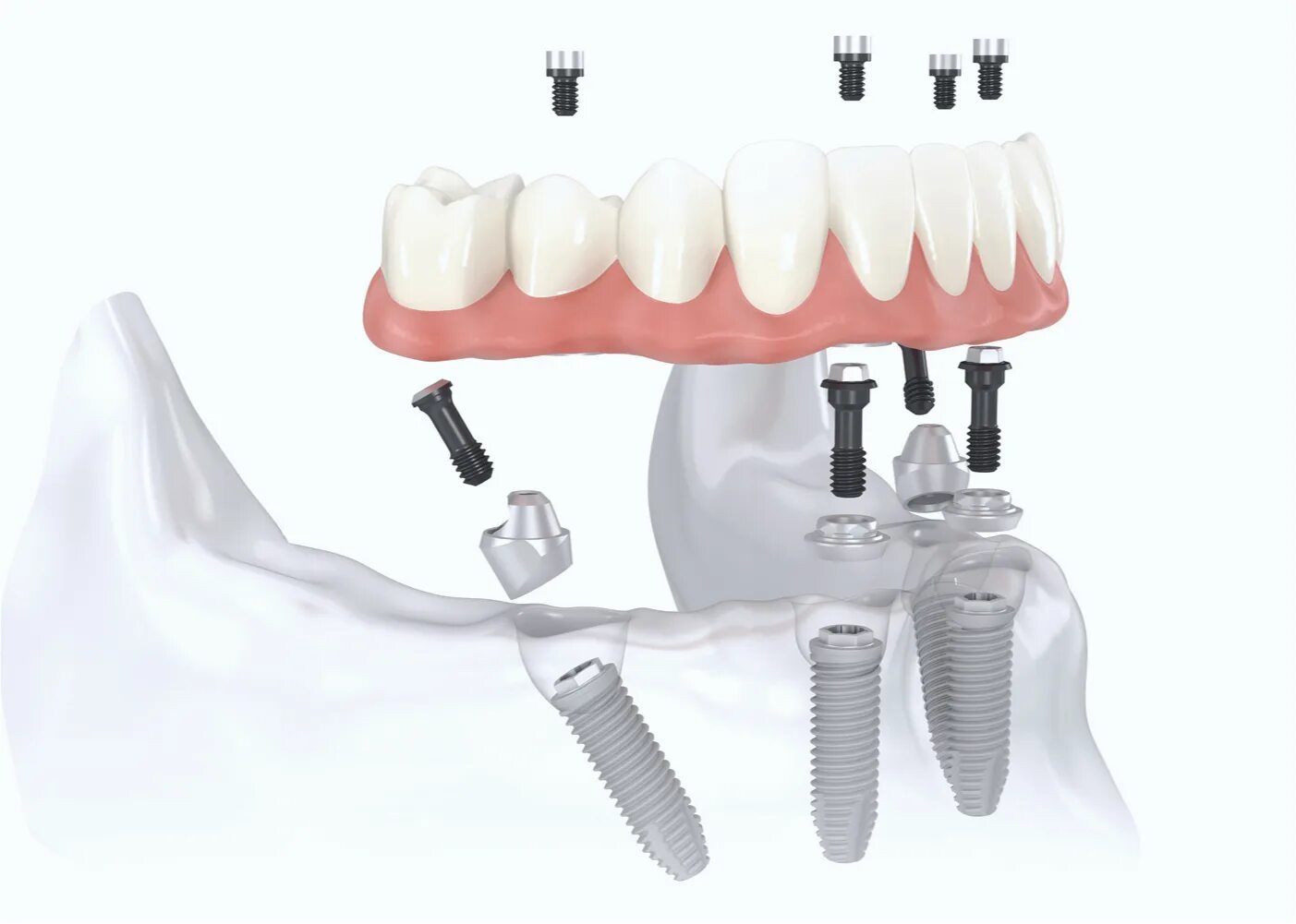 Протезирование с использованием имплантатов. Имплантологическая кассета nobel полный набор для all on 4. Балочная система фиксации протезов на имплантах несъемные. Протезирование с использованием имплантатов. Протезирование с использованием имплантатов.